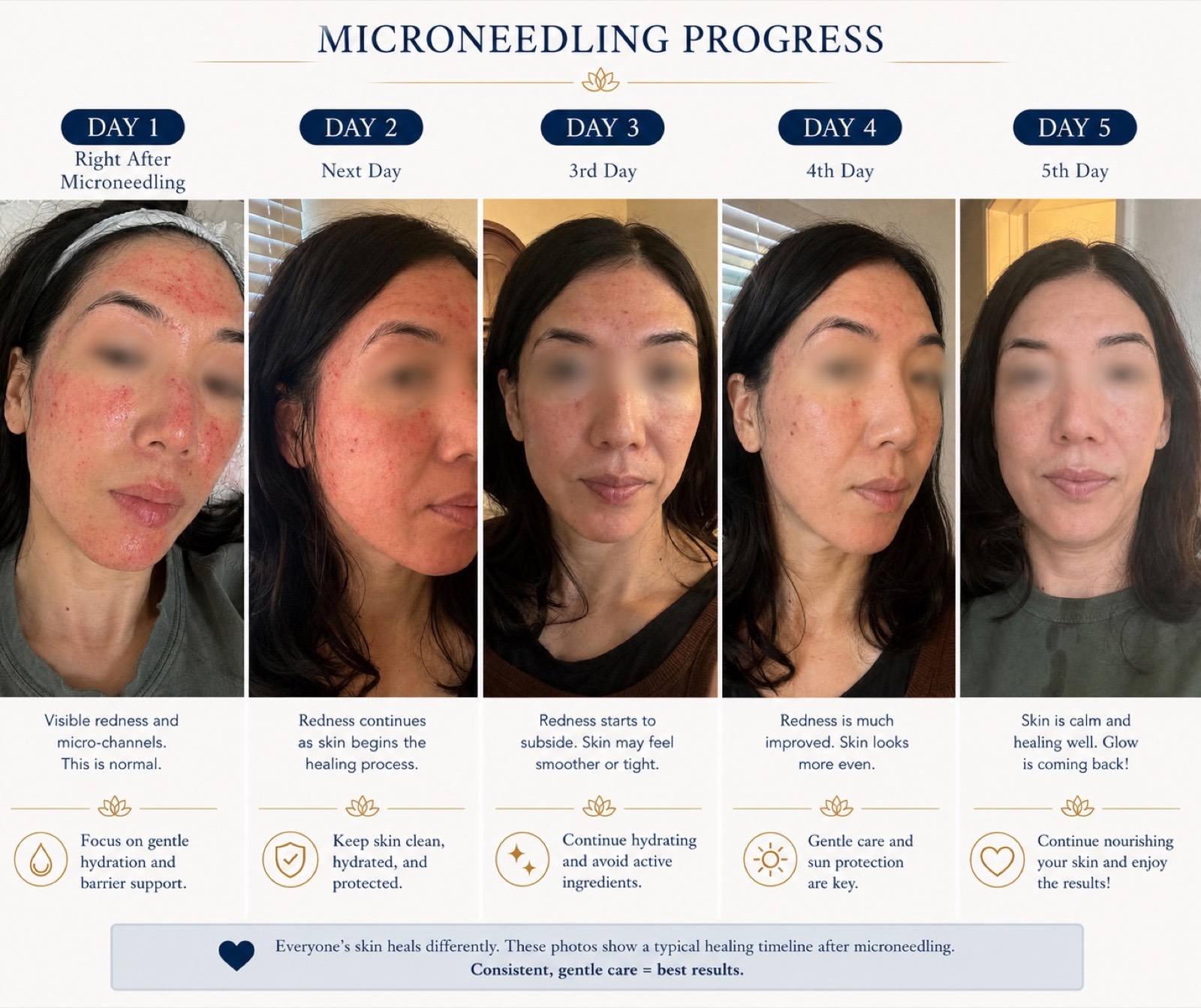 Microneedling healing progress from Day 1 through Day 5 with eyes blurred for privacy