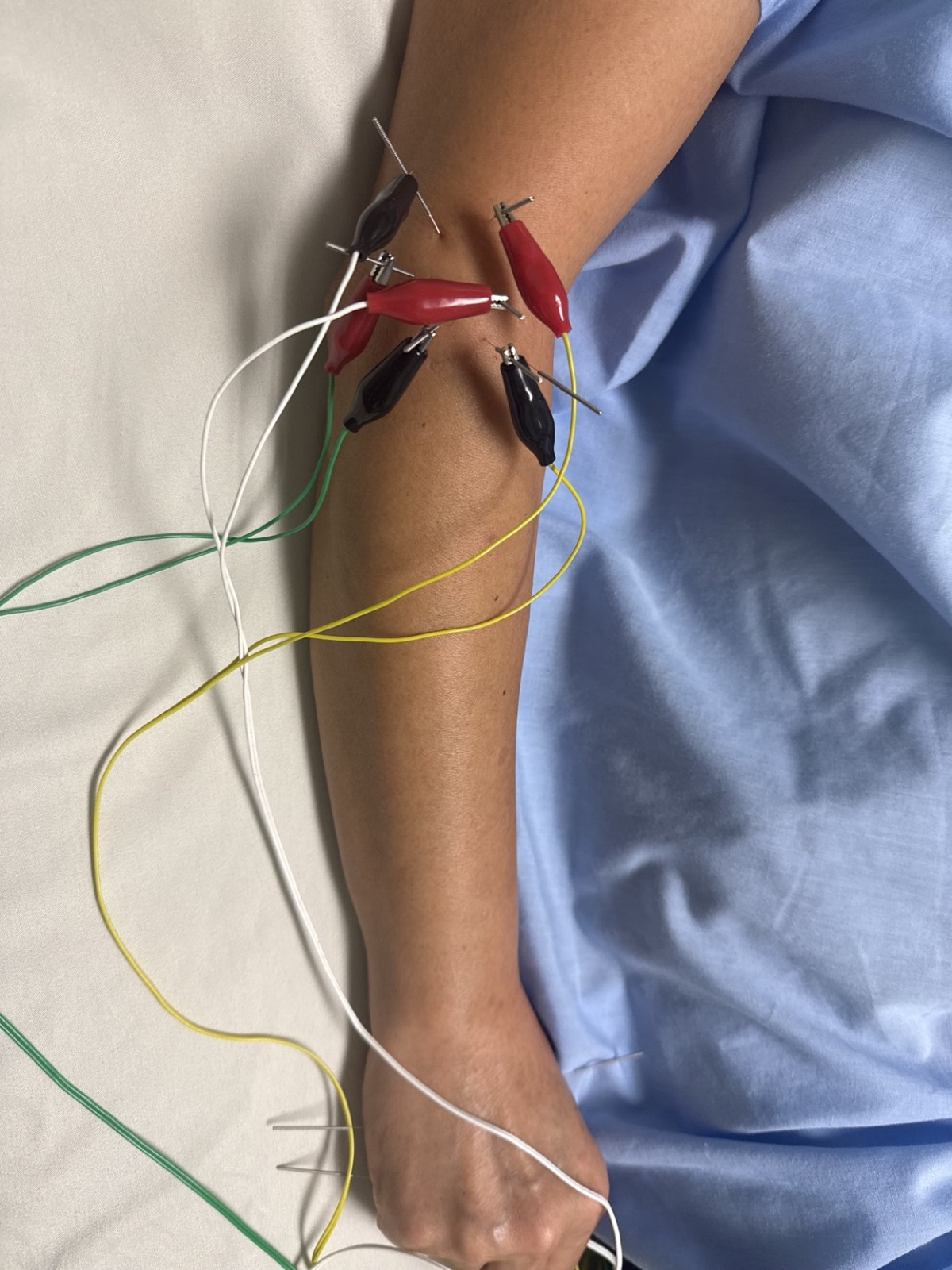 Electroacupuncture treatment on the arm